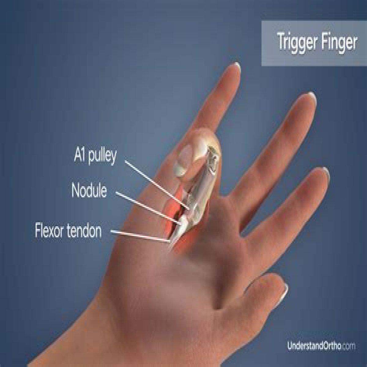 What is the CPT code for trigger finger release?